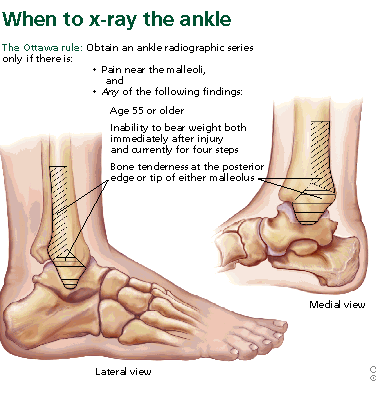 Foot2 - Ability Rehabilitation