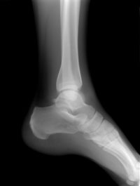 What is Ankle ORIF? - Ability Rehabilitation