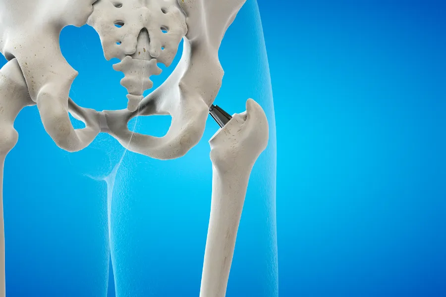 Illustration showing a hip replacement implant positioned in the hip joint